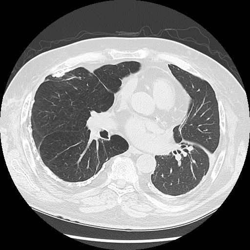 Asbestos-related pleural disease (Radiopaedia 74366-85250 Axial lung window 63).jpg