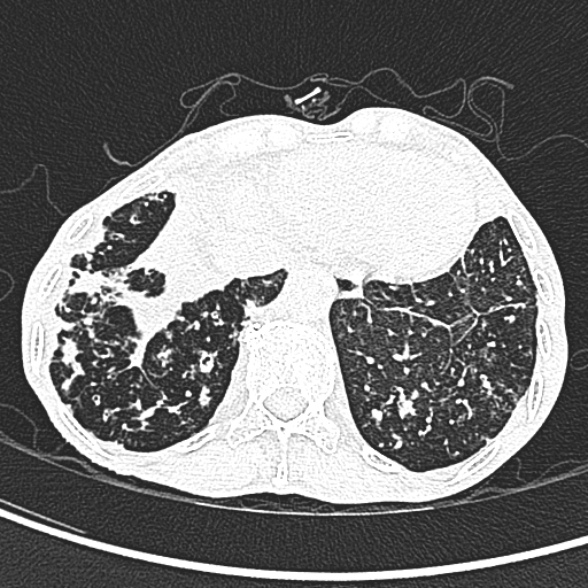 Aspergilloma- with Monod sign (Radiopaedia 44737-48532 Axial lung window 247).jpg