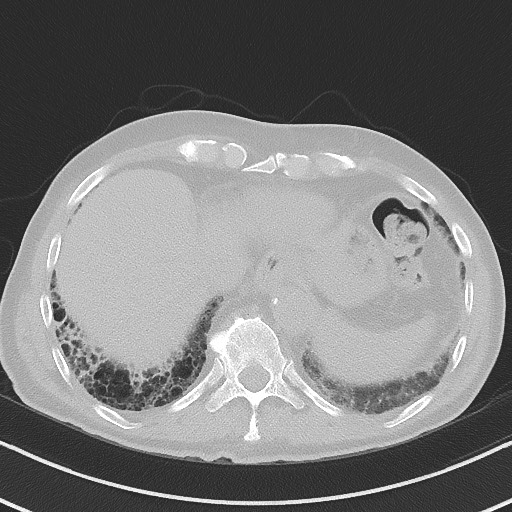 Aspergilloma on background pulmonary fibrosis (Radiopaedia 60942-68757 A 46).jpg
