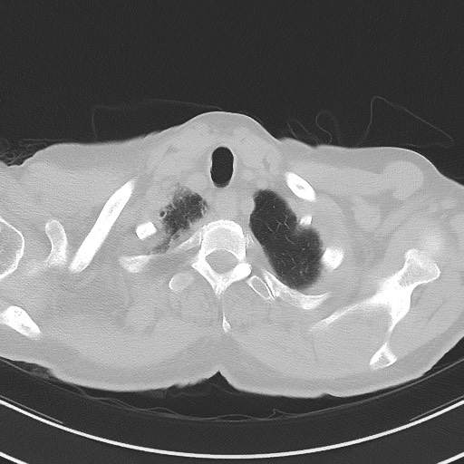 Aspergilloma on background pulmonary fibrosis (Radiopaedia 60942-68757 A 5).jpg
