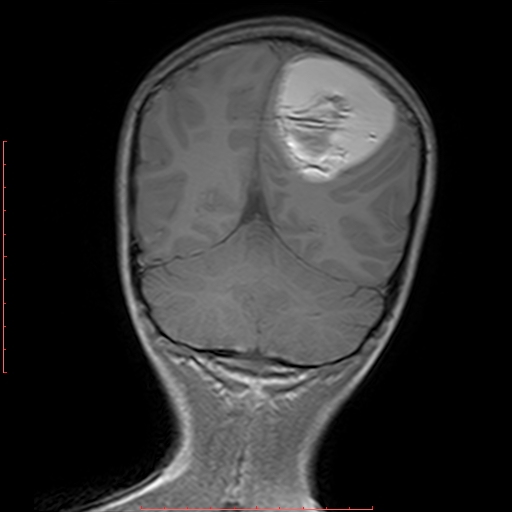 File:Astroblastoma (Radiopaedia 74287-85162 Coronal T1 18).jpg