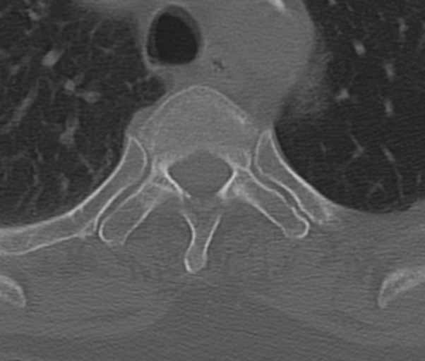 Atlanto-axial subluxation (Radiopaedia 36610-38176 Axial bone window 60).png