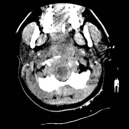 File:Atlanto-occipital dislocation (Radiopaedia 44648-48412 Axial non-contrast 5).jpg