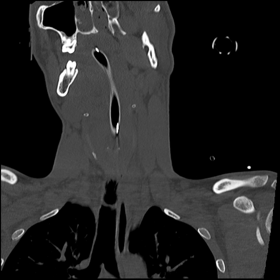 Atlanto-occipital dissociation (Traynelis type 1), C2 teardrop fracture, C6-7 facet joint dislocation (Radiopaedia 87655-104061 Coronal bone window 26).jpg