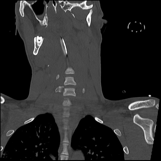 Atlanto-occipital dissociation (Traynelis type 1), C2 teardrop fracture, C6-7 facet joint dislocation (Radiopaedia 87655-104061 Coronal bone window 31).jpg