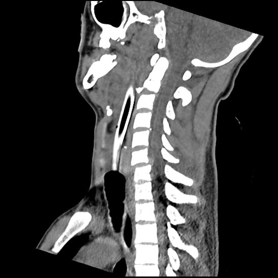 Atlanto-occipital dissociation (Traynelis type 1), C2 teardrop fracture, C6-7 facet joint dislocation (Radiopaedia 87655-104061 D 47).jpg