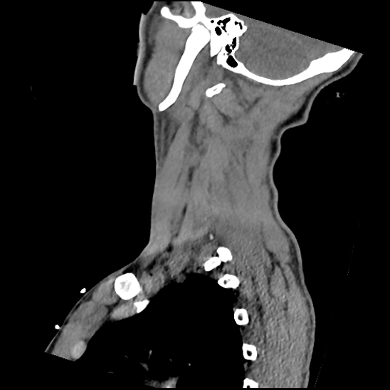 Atlanto-occipital dissociation (Traynelis type 1), C2 teardrop fracture, C6-7 facet joint dislocation (Radiopaedia 87655-104061 D 65).jpg