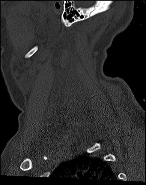 Atlanto-occipital dissociation - Traynelis type 1 (Radiopaedia 87570-103948 Sagittal bone window 69).jpg