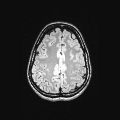 Atretic encephalocoele with inferior vermis hypoplasia (Radiopaedia 30443-31108 Axial 119).jpg