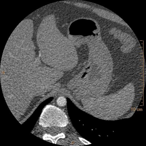 Atrial septal defect (upper sinus venosus type) with partial anomalous pulmonary venous return into superior vena cava (Radiopaedia 73228-83961 A 309).jpg
