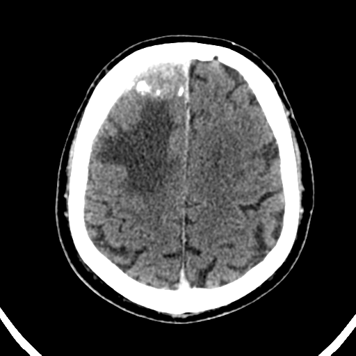 Atypical meningioma (WHO grade II) with brain invasion (Radiopaedia 57767-64728 Axial C+ 16).png