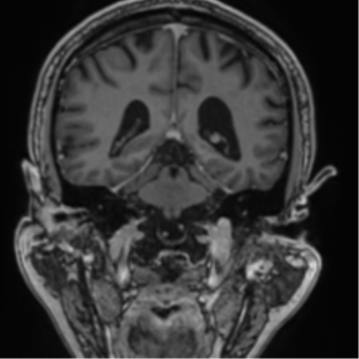 Atypical meningioma (WHO grade II) with brain invasion (Radiopaedia 57767-64729 Coronal T1 C+ 53).png