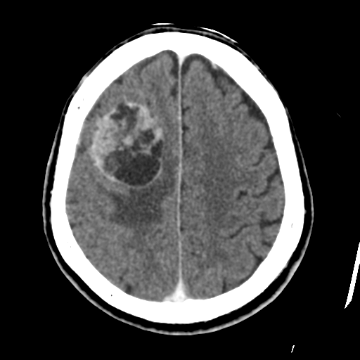 Atypical meningioma (WHO grade II) with osseous invasion (Radiopaedia 53654-59715 Axial C+ delayed 39).png