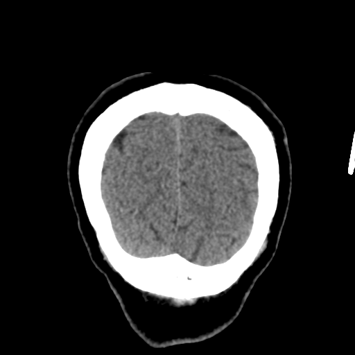 Atypical meningioma (WHO grade II) with osseous invasion (Radiopaedia 53654-59715 Coronal non-contrast 57).png