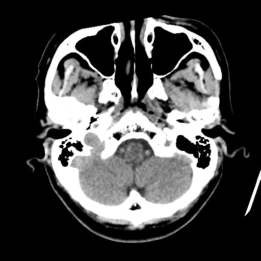 Atypical meningioma with skull invasion (Radiopaedia 34357-35649 Axial non-contrast 10).png