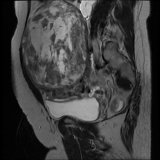 File:Atypical retroperitoneal lymphocoeles with large leiomyoma of uterus (Radiopaedia 32084-33027 Sagittal T2 11).jpg