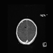 Atypical teratoid rhabdoid tumor (prenatal US and neonatal MRI) (Radiopaedia 59091-66388 Axial T1 C+ 50).jpg