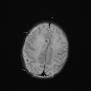 File:Atypical teratoid rhabdoid tumor (prenatal US and neonatal MRI) (Radiopaedia 59091-66388 Axial T2 24).jpg