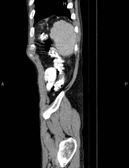 Autoimmune pancreatitis (Radiopaedia 84925-100431 E 88).jpg