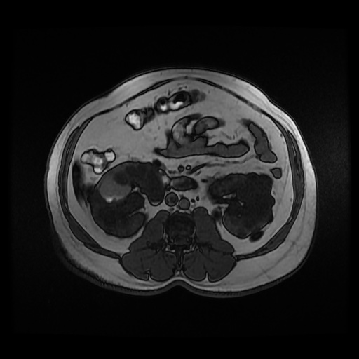 Autosomal dominant polycystic kidney disease (Radiopaedia 50259-55611 Axial 2D Dual Echo 51).jpg