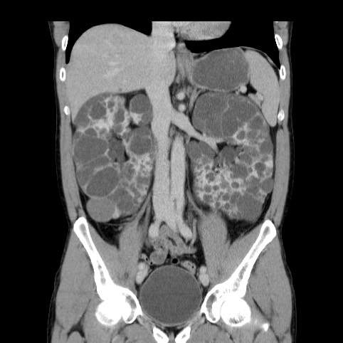 Autosomal dominant polycystic kidney disease (Radiopaedia 66349-75582 A 40).jpg