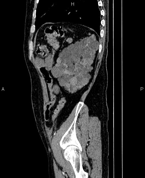 Autosomal dominant polycystic kidney disease (Radiopaedia 87830-104287 C 76).jpg