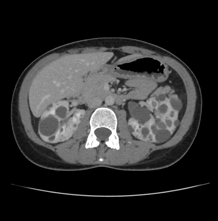 Autosomal dominant polycystic kidney disease - early onset (Radiopaedia 40734-43387 A 30).jpg