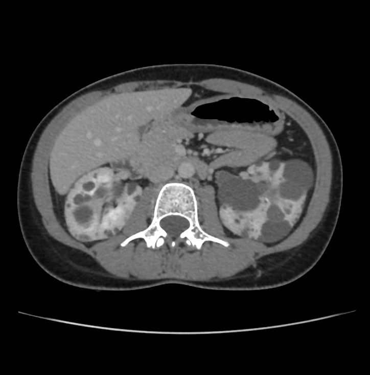 Autosomal dominant polycystic kidney disease - early onset (Radiopaedia 40734-43387 A 32).jpg