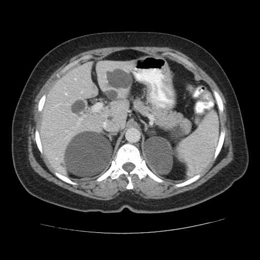 File:Autosomal dominant polycystic kidney disease with hepatic involvement (Radiopaedia 32693-33662 B 19).jpg
