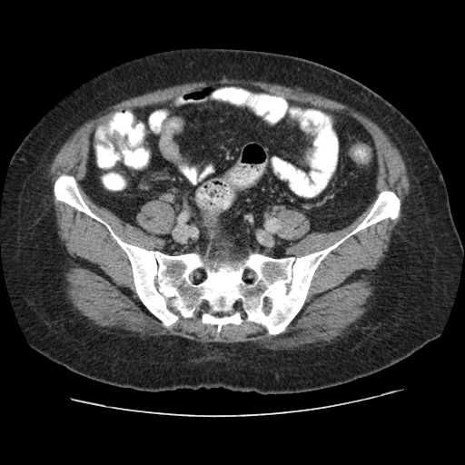 Autosomal dominant polycystic kidney disease with hepatic involvement (Radiopaedia 32693-33662 B 60).jpg