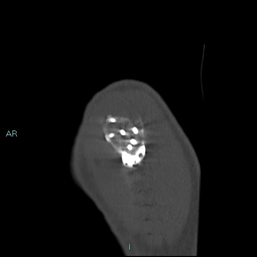 Avascular necrosis after fracture dislocations of the proximal humerus (Radiopaedia 88078-104653 Sagittal bone window 13).jpg