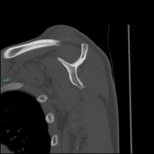 Avascular necrosis after fracture dislocations of the proximal humerus (Radiopaedia 88078-104653 Sagittal bone window 44).jpg