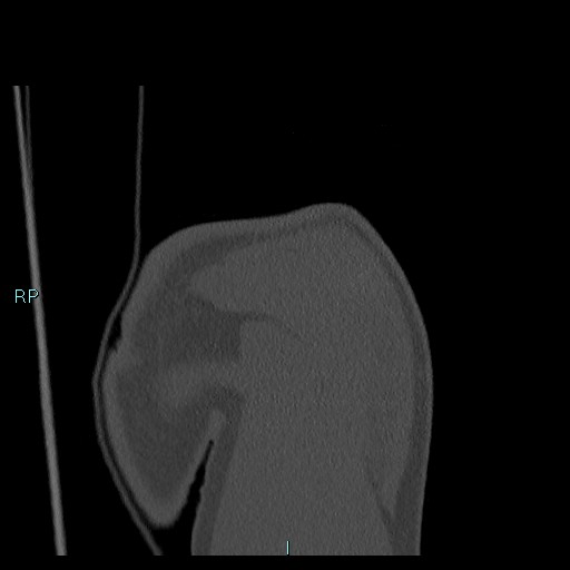 Avascular necrosis after fracture dislocations of the proximal humerus (Radiopaedia 88078-104655 Coronal bone window 34).jpg
