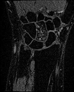 Avascular necrosis of the capitate (Radiopaedia 88317-104948 Coronal T1 vibe 39).jpg
