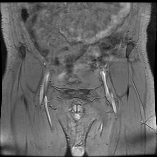 Avascular necrosis of the hip (Radiopaedia 61503-69465 F 2).jpg