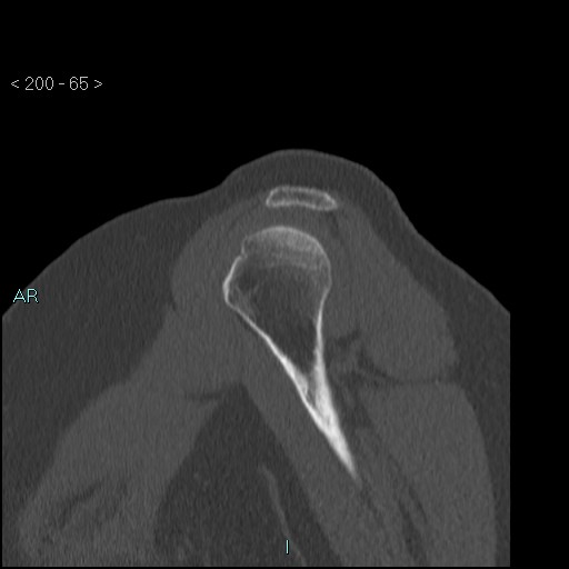 Avascular necrosis of the shoulder - Cruess stage I (Radiopaedia 77674-89887 Sagittal bone window 64).jpg