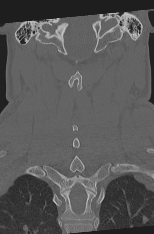 Axis peg fracture (type 3) and atlas lateral mass (type 4) fracture (Radiopaedia 37474-39324 Coronal bone window 39).png