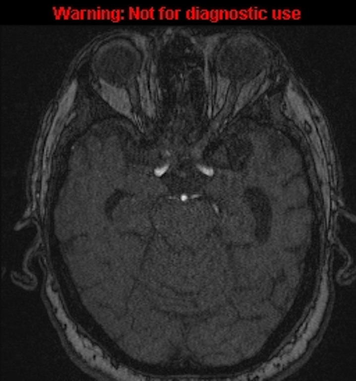 Azygos anterior cerebral artery (Radiopaedia 59325-66677 Axial MRA 59).jpg