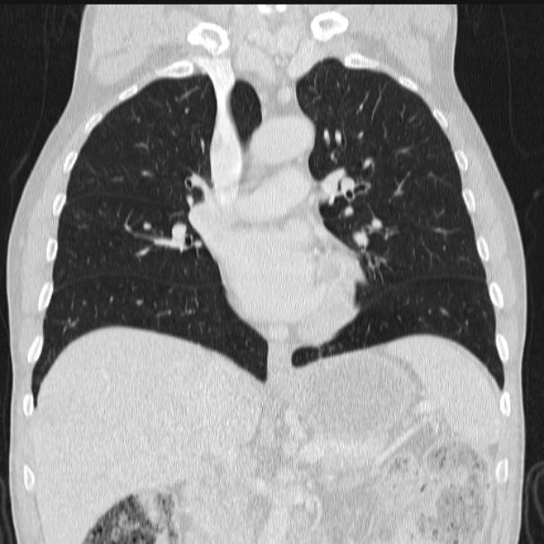 Azygos lobe (Radiopaedia 38259-40275 Coronal lung window 38).jpg