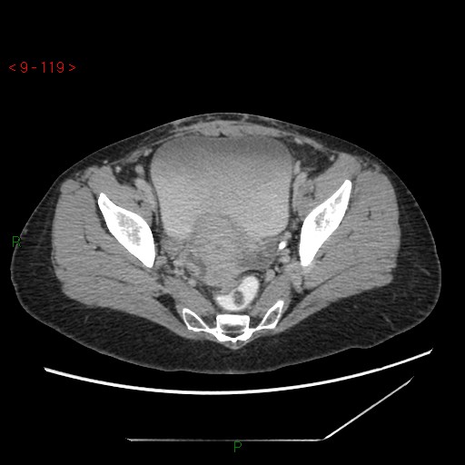 File:Bartholin gland cyst (Radiopaedia 54904-61181 Axial C+ delayed 30).jpg
