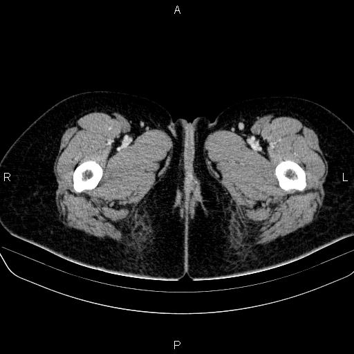 File:Bartholin gland cyst (Radiopaedia 62635-70930 Axial Post contrast 103).jpg