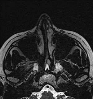 Basal cell carcinoma - nasal region (Radiopaedia 70292-80365 Axial Gradient Echo 18).jpg