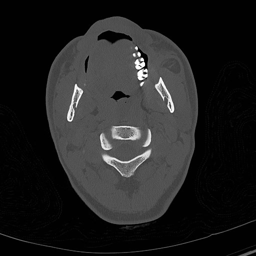 Base of skull fracture with bilateral Le Fort fractures (Radiopaedia 47094-51638 Axial bone window 7).jpg