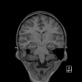 Base of skull rhabdomyosarcoma (Radiopaedia 32196-33142 Coronal T1 27).jpg