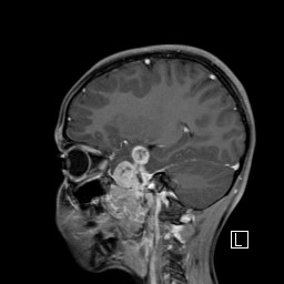 Base of skull rhabdomyosarcoma (Radiopaedia 32196-33142 J 23).jpg