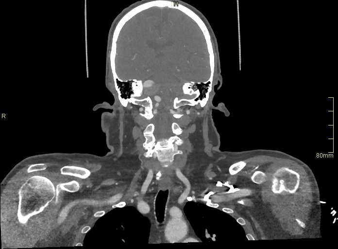 Basilar artery aneurysm (Radiopaedia 56261-62932 B 34).jpg