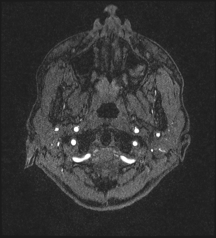 Basilar artery perforator aneurysm (Radiopaedia 82455-97733 Axial MRA 1).jpg