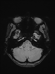 File:Basilar artery perforator aneurysm (Radiopaedia 82455-97733 Axial SWI 9).jpg