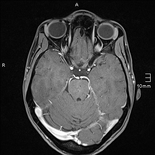 Basilar artery perforator aneurysm (Radiopaedia 82455-99523 G 49).jpg