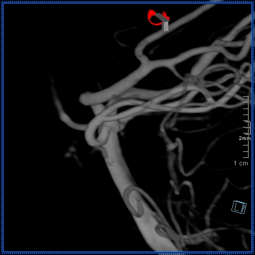 File:Basilar artery perforator aneurysm (Radiopaedia 82455-99524 3D Left VA 16).jpg
